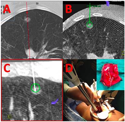 Value of the Hybrid Operating Theater for an Integrated Approach to Diagnosis and Treatment of Pulmonary Nodules in 2019